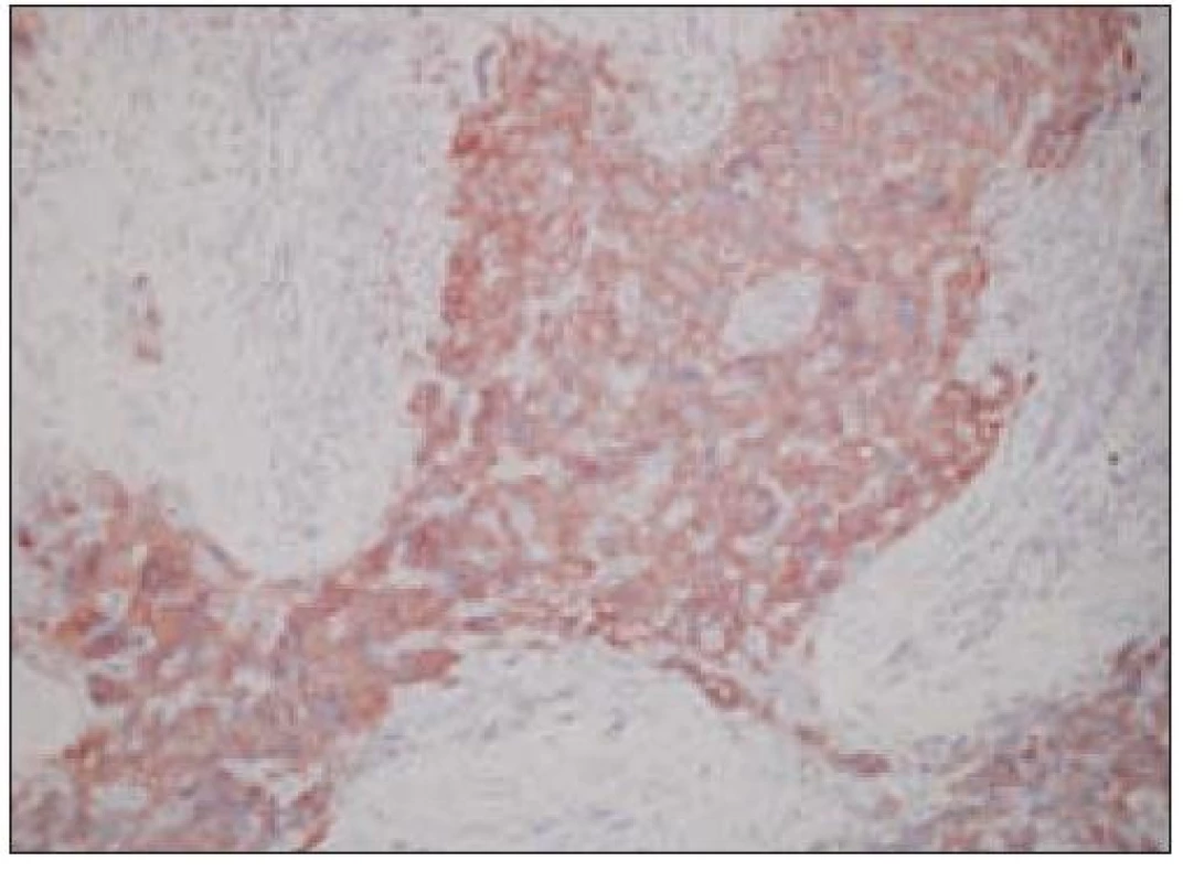 Sarkóm folikulových dendritických buniek, CD21&lt;sup&gt;+&lt;/sup&gt; (40krát).
