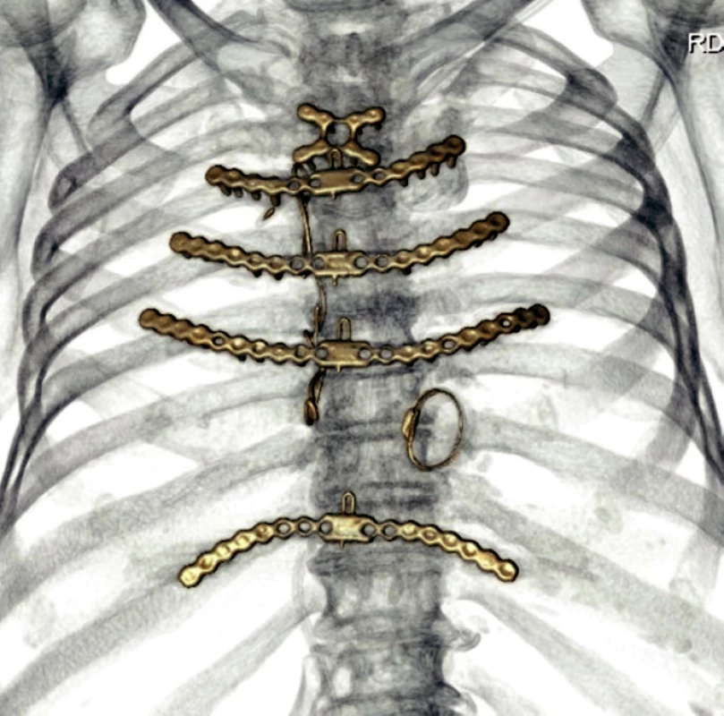 CT hrudníku – 3D rekonstrukce.