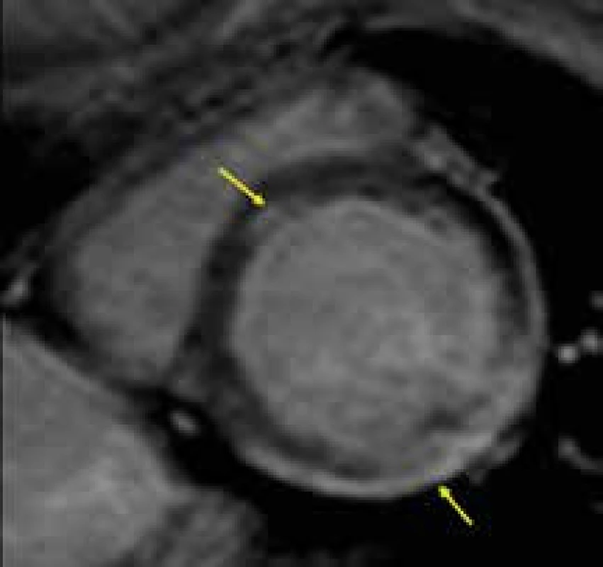Táhlý subepikardiální pruh pozdního sycení kontrastní látkou (LGE) posterolaterálně a izolované midmoykardiální ložisko LGE ve středu septa komor (žluté šipky) u nemocného s kardiomyopatií při Duchenneově svalové dystrofii;