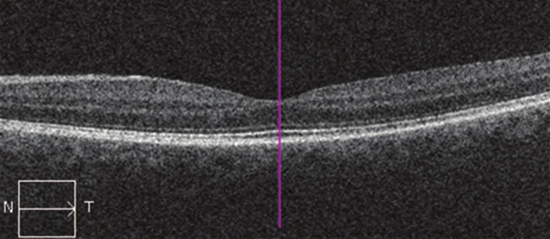 Nález na OCT na levém oku po roce po PDT (HD OCT Cirrus)