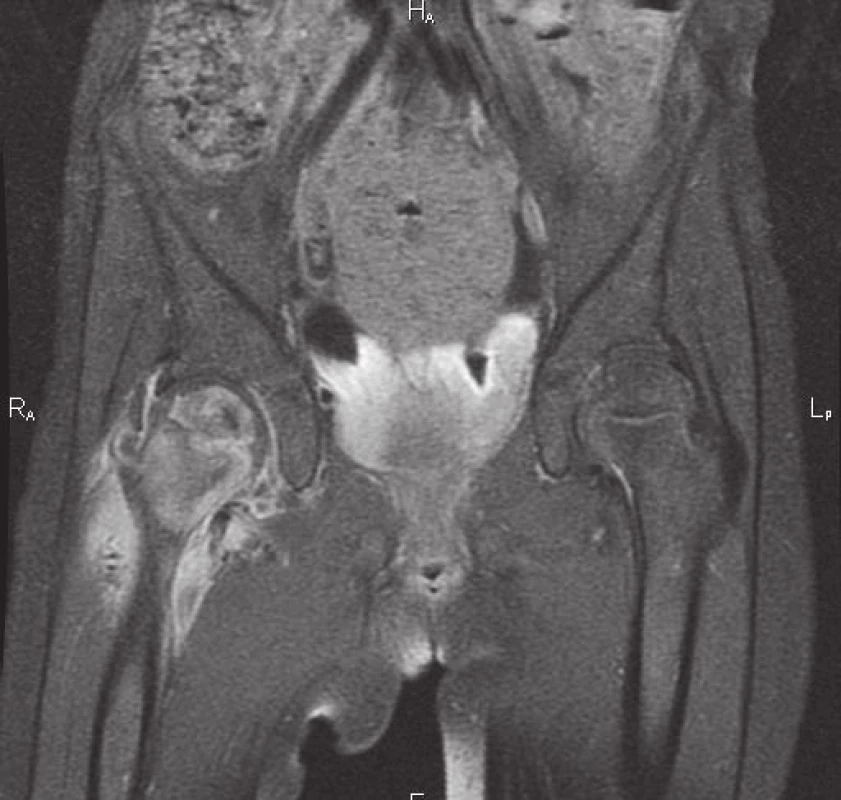 Nález na MRI 4 týdny od prvních projevů infekce &lt;i&gt;M. avium&lt;/i&gt;: edém proximálního femuru a přilehlých měkkých tkání, v osifikačním jádru hlavice nekróza, kraniálně absces, nekróza v mediální části krčku.
Fig. 4. MRI imaging 4 weeks after the onset of symptoms of &lt;i&gt;M. avium&lt;/i&gt; infection: proximal femur and adjacent soft tissue oedema, necrosis in ossification centre and abscess of right femoral head, necrosis in medial aspect of right femoral neck.