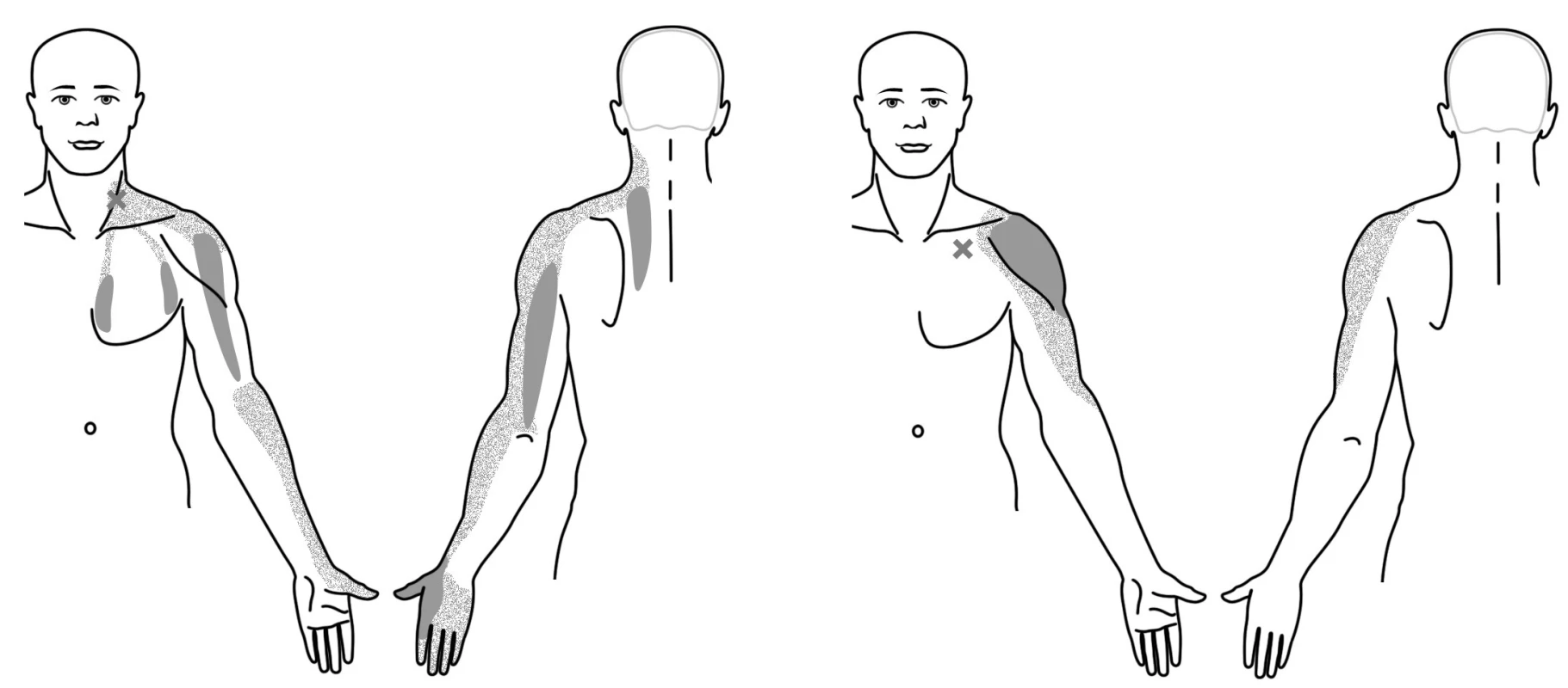 Trigger pointy v oblasti ramene a předloktí