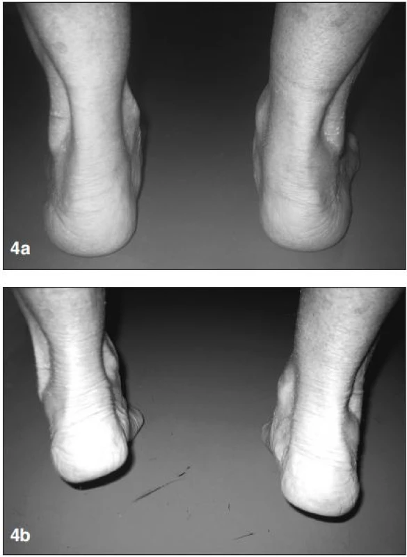 &lt;strong&gt;a)&lt;/strong&gt; v zatížení patrná vpravo valgózní deviace paty a planovalgózní postavení nohy, &lt;strong&gt;b)&lt;/strong&gt; při stoji na špičkách nedochází ke korekci valgózní deviace paty – známky dysfunkce šlachy m. tibialis posterior.