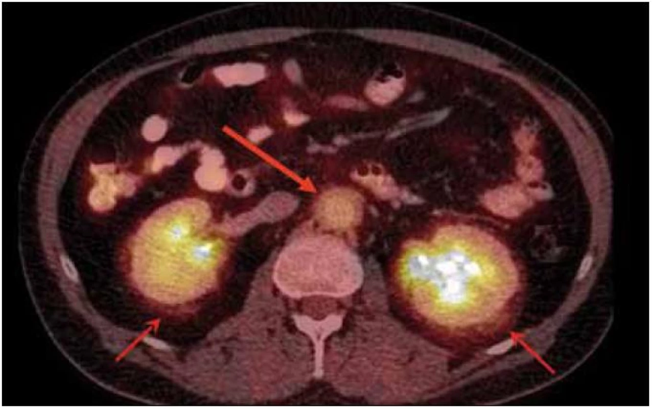 PET-CT pacienta s Erdheimovou-Chesterovou nemocí, která se projevuje fibrózou retroperitona. Šipkami označena perirenální fibróza a dále zesílení stěny aorty s fibrotickými změnami v jejím okolí. Fibróza retroperitonea může vést až k hydronefróze.