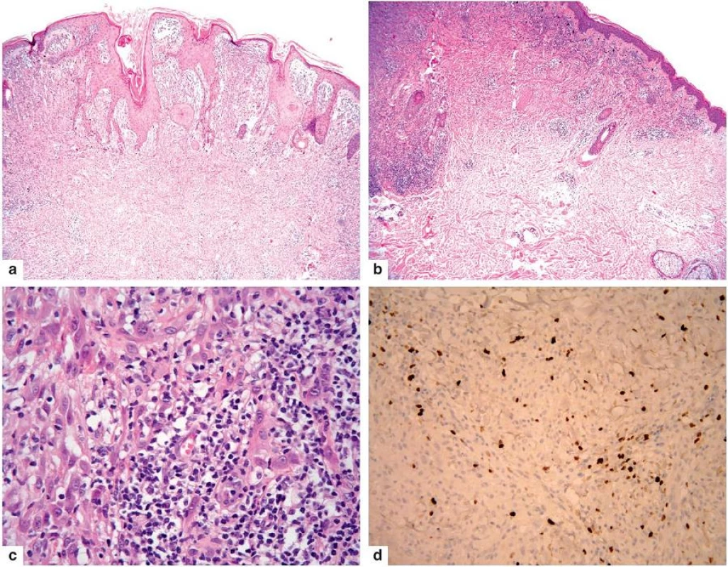 Spitzoidní melanom
a – verukózní tumor s nepravidelně hyperplastickou epidermis
b – dosti husté infiltráty lymfocytů v něm
c – v nich jsou melanocyty s hyperchromními jádry a prominujícími jadérky
d – tyto vykazují vysokou proliferační aktivitu i v dolní části léze (Ki-67)