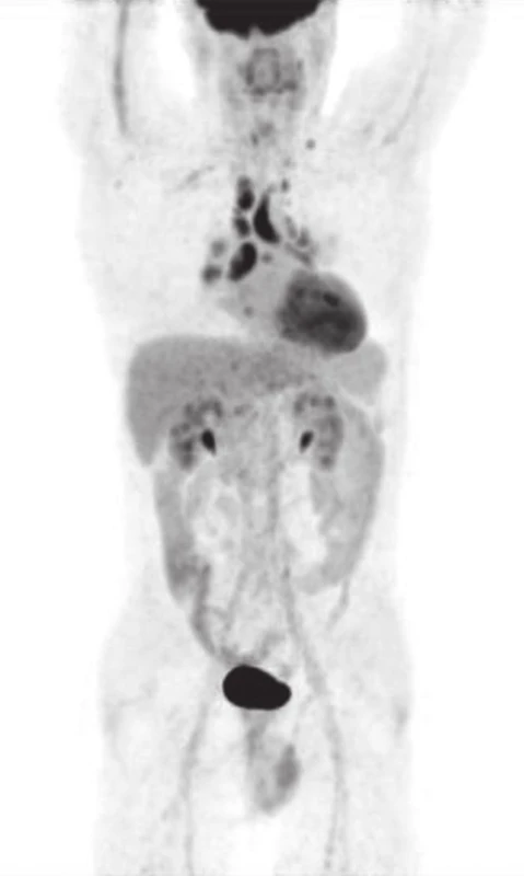 Pacient č.1, IV/2012 PET/CT (MIP).