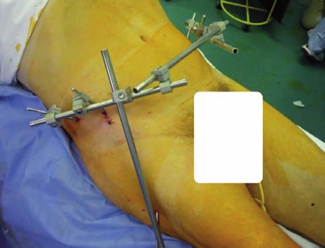 Zevní fixace při stabilizaci zlomenin pánve při současné zlomenině acetabula jako metoda DCO (na obrázku poranění pravého acetabula)