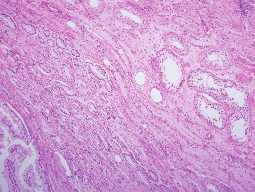 Histologický nález: infiltrace tkáně varlete metastatickým hůře diferencovaným invazivním adenokarcinomem prostaty (standardní barvení HaE, původní zvětšení 100krát)