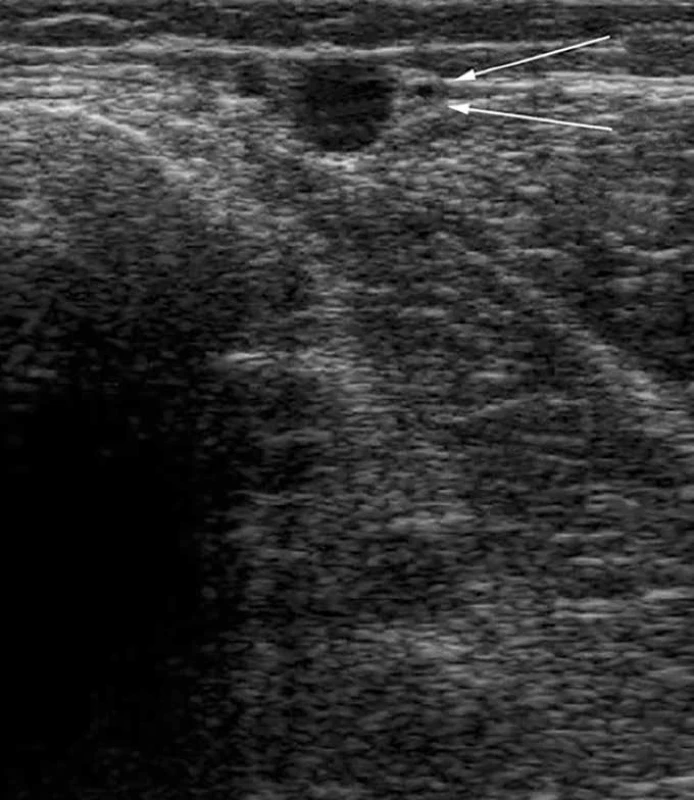 Ultrazvukový obrázek transverzálního řezu proximální částí nohy – tibiogastroknemický trojúhelník či úhel.