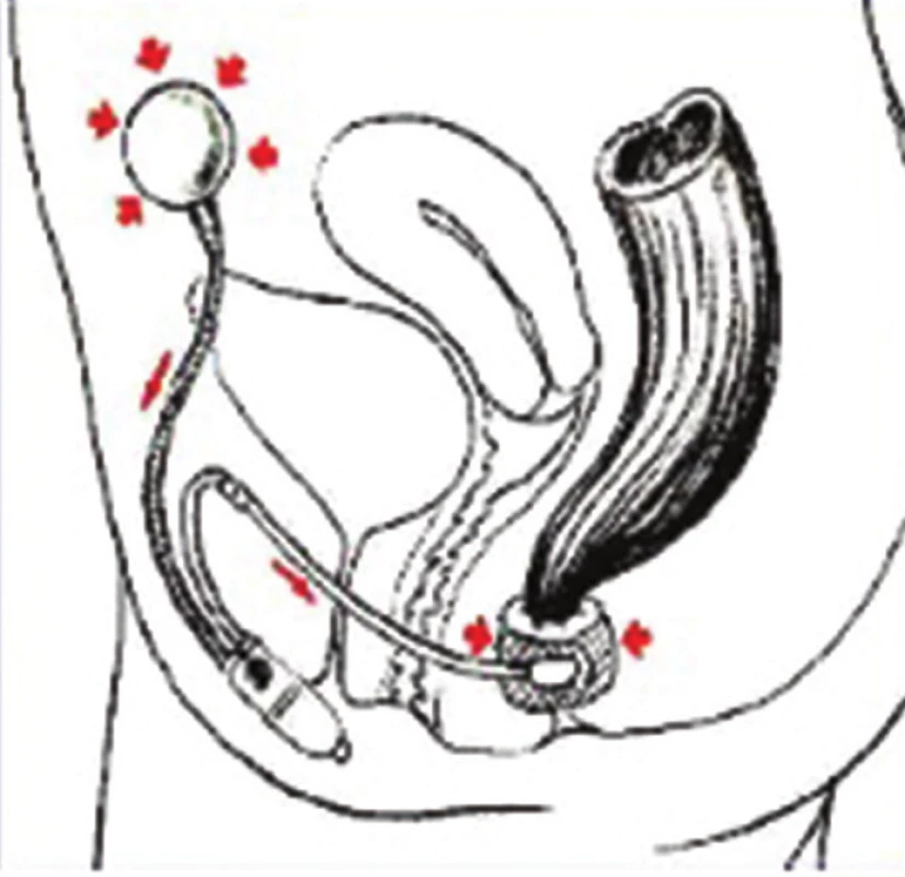 Umělý svěrač anu Acticon Neosphincter – schematické znázornění umístění a funkce
Fig. 2: Artificial anal sphincter Acticon Neosphincter – placement and function