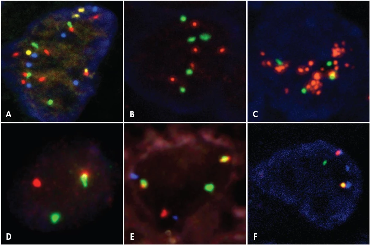 Příklady výsledků I-FISH na histologických řezech – jednotlivá jádra nádorových buněk
A. &lt;em&gt;Melanom s komplexními změnami&lt;/em&gt; – 8 signálů genu &lt;em&gt;RREB1&lt;/em&gt; (Spectrum Red), 4 signály genu &lt;em&gt;MYB&lt;/em&gt; (Spectrum Gold), 4 signály genu &lt;em&gt;CCND1&lt;/em&gt; (Spectrum Green), 6 signálů pro centromeru chromozomu 6 (Spectrum Aqua), jádro dobarveno DAPI (Vysis). B. &lt;em&gt;Invazivní duktální karcinom mléčné žlázy s polyzomií chromozomu 17&lt;/em&gt; – 5 signálů genu &lt;em&gt;ERBB2&lt;/em&gt; (Red fluorochrome), 5 signálů pro centromeru chromozomu 17 (Green fluorochrome), jádro dobarveno DAPI (Pan Path). C. &lt;em&gt;Invazivní duktální karcinom mléčné žlázy s amplifikací genu ERBB2 a polyzomií chromozomu 17&lt;/em&gt; – gen &lt;em&gt;ERBB2&lt;/em&gt; (Red fluorochrome), centromera chromozomu 17 (Green fluorochrome), jádro dobarveno DAPI (Pan Path). D. &lt;em&gt;Burkittův lymfom se zlomem v oblasti genu MYC&lt;/em&gt; – systém „dual color break-apart“, ZyGreen (sonda nasedající za místo zlomu genu &lt;em&gt;MYC&lt;/em&gt; směrem k telomeře) a ZyOrange (sonda nasedající za místo zlomu genu &lt;em&gt;MYC&lt;/em&gt; směrem k centromeře), jádro dobarveno DAPI (Zyto Vision). E. &lt;em&gt;Burkittův lymfom s translokací t(8;14)(q24;q32)&lt;/em&gt; – systém „dual color dual fusion“ s přidanou sondou centromerickou, gen &lt;em&gt;MYC&lt;/em&gt; (Spectrum Orange), gen &lt;em&gt;IGH&lt;/em&gt; (Spectrum Green), centromera chromozomu 8 (Spectrum Aqua), (Vysis). F. &lt;em&gt;Karcinom plic s inverzí inv(2 (p21p23)&lt;/em&gt; – gen &lt;em&gt;ALK&lt;/em&gt; (ZyGreen – sonda nasedající za místo zlomu &lt;em&gt;ALK&lt;/em&gt; genu směrem k centromeře a ZyRed – sonda nasedající za místo zlomu &lt;em&gt;ALK&lt;/em&gt; genu směrem k telomeře; při inverzi jsou zelené a červené signály oddáleny), gen &lt;em&gt;EML4&lt;/em&gt; (ZyBlue – sonda překrývající oblast před i za místem zlomu genu &lt;em&gt;EML4&lt;/em&gt;, při inverzi vznikají dva signály), jádro dobarveno DAPI (Zyto Vision). Vzdálenost mezi oddáleným zeleným a červeným signálem je v případě paracentrické inverze menší než u zlomu genu a translokaci na jiný chromozom, jak je vidět při porovnání obr 4D a 4F.