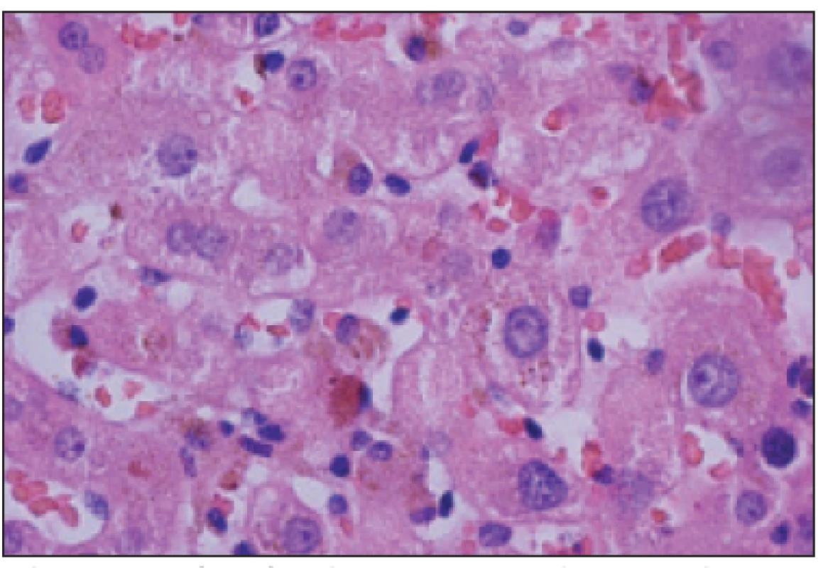 Histologický obraz pečene – obraz intrahepatocytárnej cholestázy.