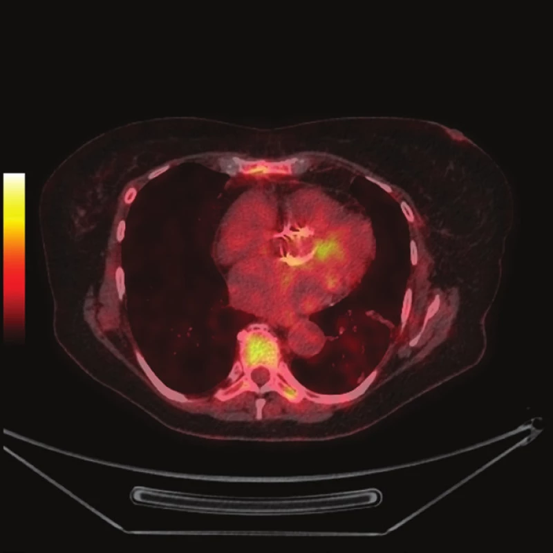 FDG PET/CT z 10.9.2012
1a - předozadní maximum intensity projection (MIP)
1b - PET s korekcí na atenuaci, axiální řez srdcem v úrovni aortálního anulu, je patrná diskrétně zvýšená akumulace FDG při aortálním anulu (šipka)
1c - PET bez korekce na atenuaci, ve stejné rovině jako 1b
1d - fúze PET/CT, ve stejné rovině jako 1b
