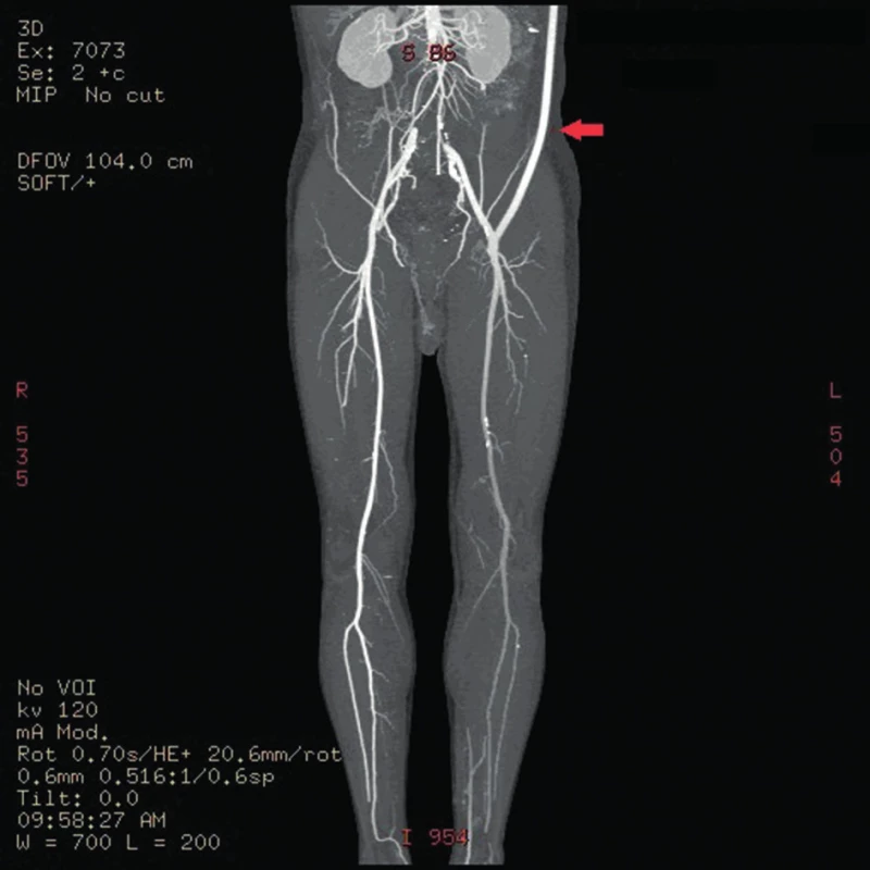 CT angiography showing functional left-sided axillofemoral bypass (arrow)