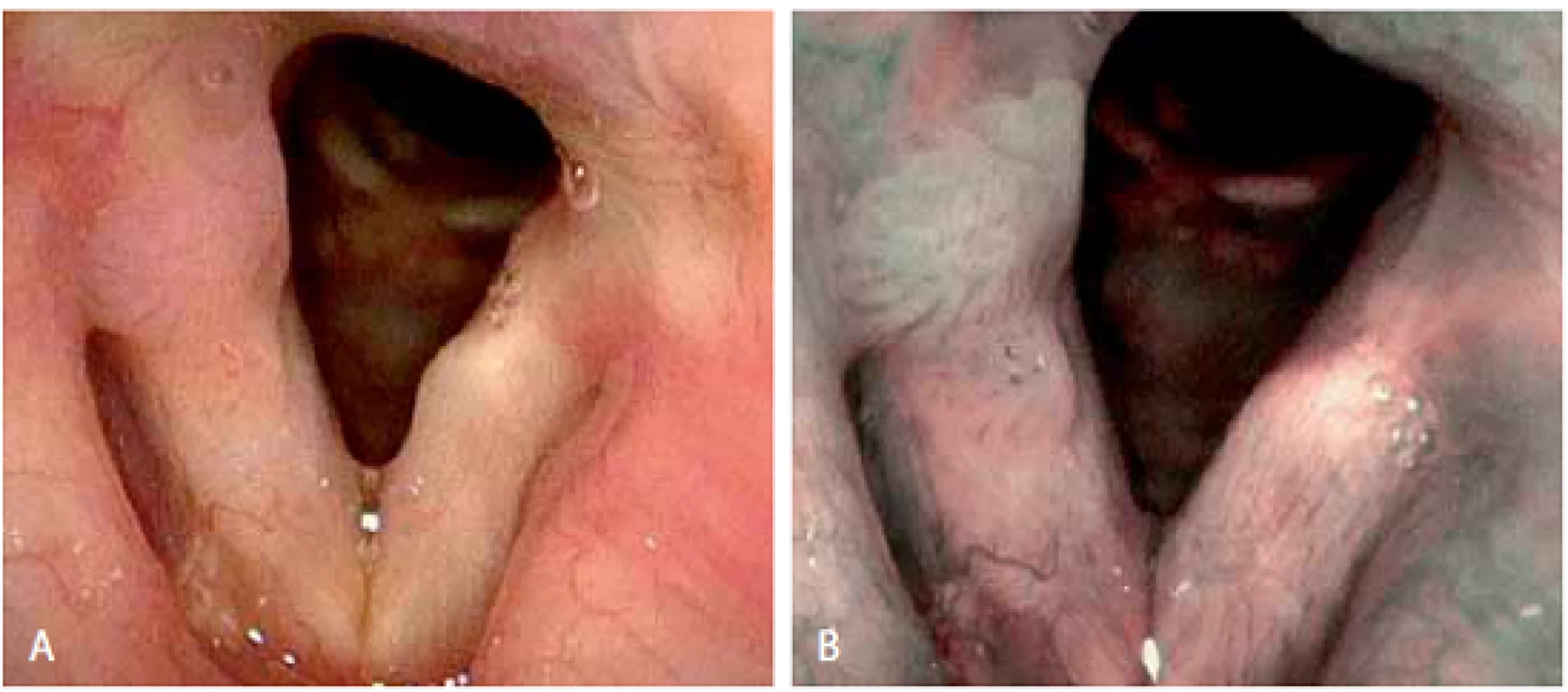 Porovnání zobrazení léze pravé hlasivky při flexibilní endoskopii bílým světlem (A) a při NBI endoskopii (B) – v NBI endoskopii větší plošný rozsah léze, vaskularizace typ IV, histologicky prokázán papilom.