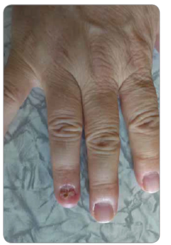 Po operácii – glomus tumor nechta 4. prsta pravej ruky