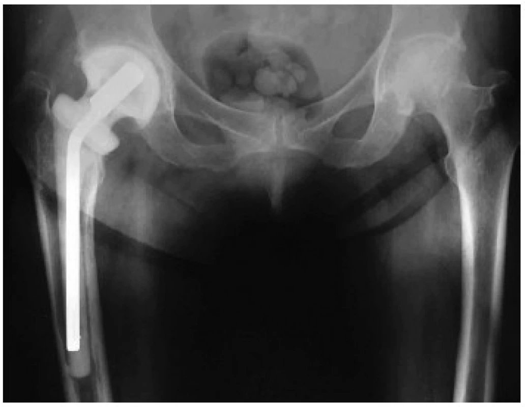 Rentgenový snímek implantovaného ready-made spaceru kyčelního kloubu
Významnou výhodou je zachování délky končetiny.
Fig 1. An X-ray of an implanted ready-made total hip spacer, having the advantage of preserving limb length