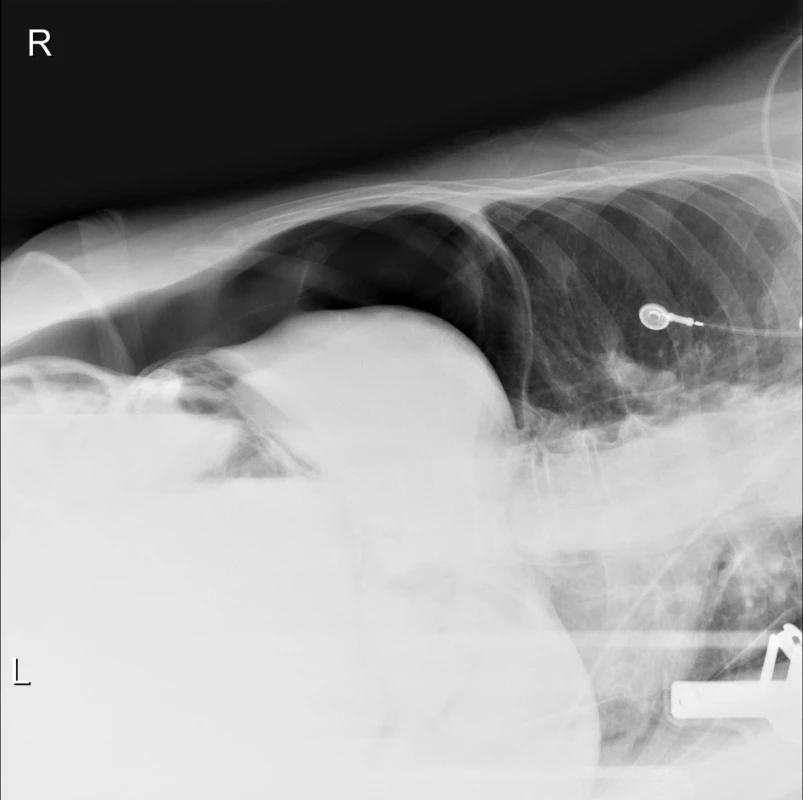 Nativní RTG snímek břicha: pneumoperitoneum u imobilního pacienta na laterogramu