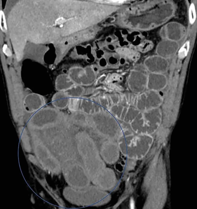 Absencia kontrastného zosilnenia steny čreva    Fig. 5: Absence of contrast enhancement of the intestinal wall