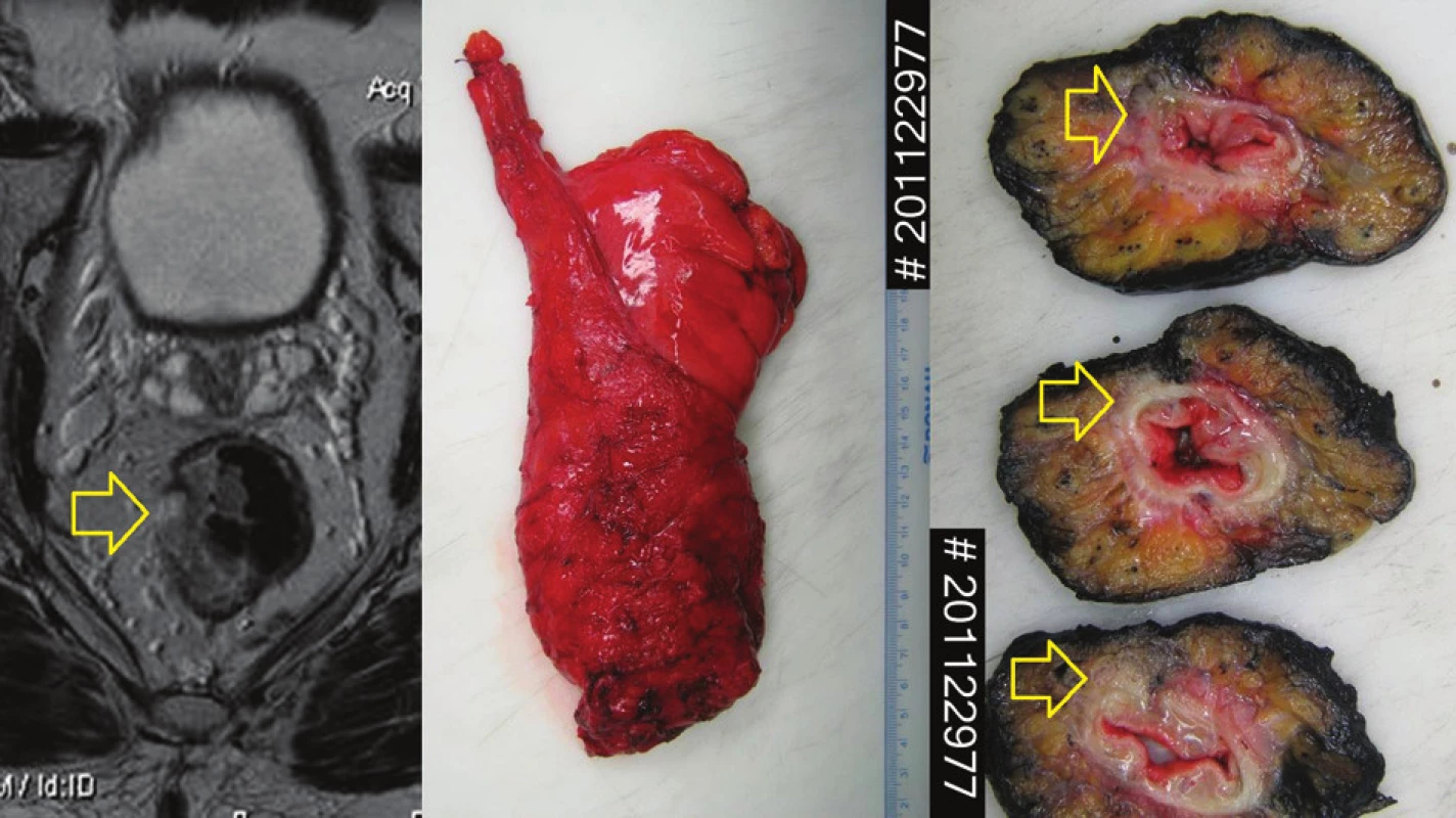 Diagnosticko-léčebná sekvence Vlevo MRI pacienta s lokálně pokročilým nádorem střední části rekta cTc, 3N1, cM0. Uprostřed makrofotografie resekčního výkonu, kvalita excize: kompletní, vpravo příčné řezy identifikující nádor: pT3, ypCRO negativní.
Fig. 2: MRI of localy advanced rectal cancer in a male patient cT3, cN1, cM0 (left) The macrophotography of resected specimen, mesorectal excision quality: complete. Axial sections of specimen in the same patient: ypT3, ypCRM negative.
