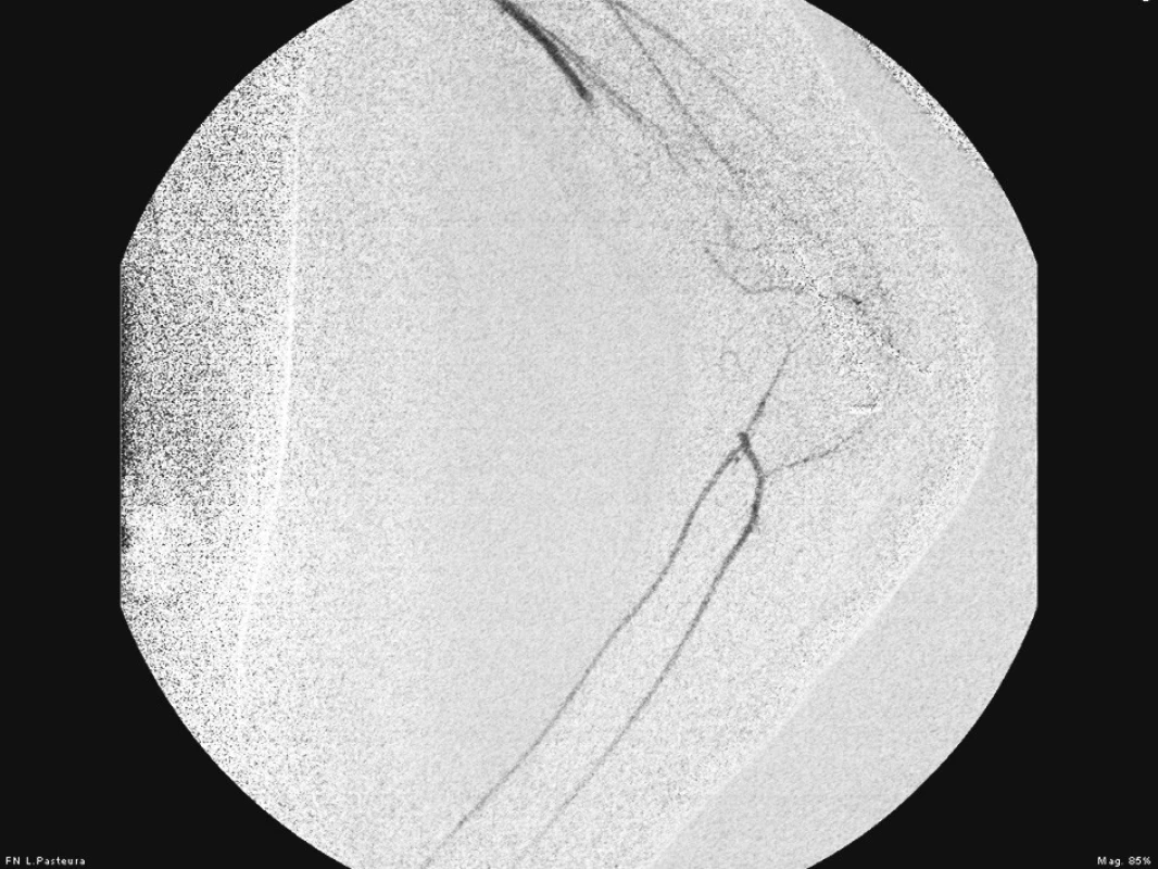 Prvotná poúrazová angiografia pred rekonštrukciou a. brachialis
Fig. 1. Initial posttraumatic angiography prior to the brachial artery reconstruction
