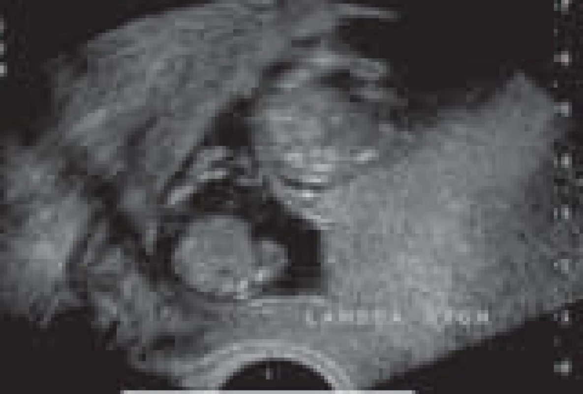 Bichoriální biamniální gravidita – ultrazvukový lambda znak bichoriální gestace.