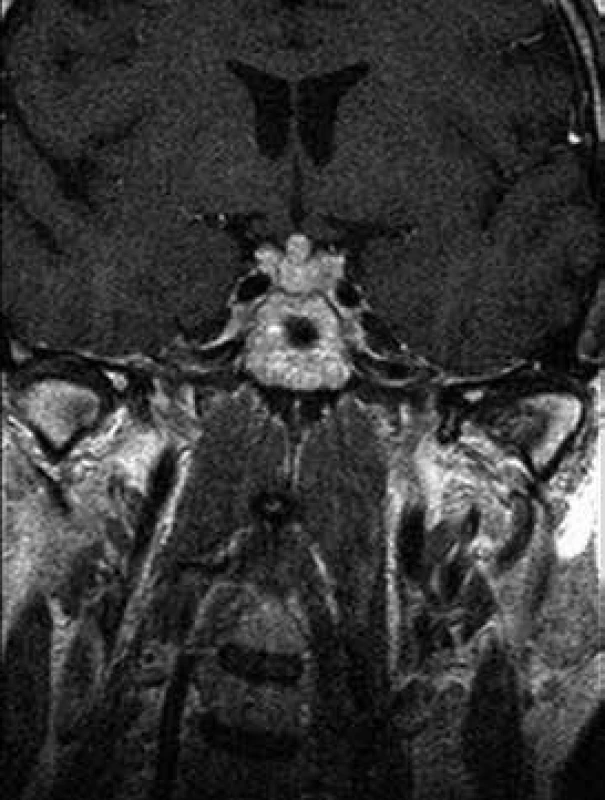 MRI mozku s aplikací kontrastní látky