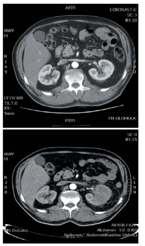 Srovnání CT vyšetření v intervalu 8 měsíců
Fig. 1. The comparison of CT scan during 8 months