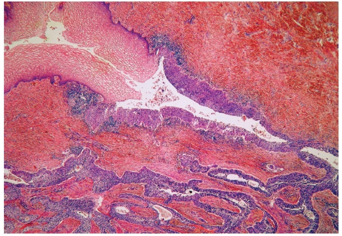 Normal squamous epithelium (upper left) and dysplastic epithelium lining invagination with apparent transition into invasive squamous cell carcinoma (H&amp;E, original magnification 100x).