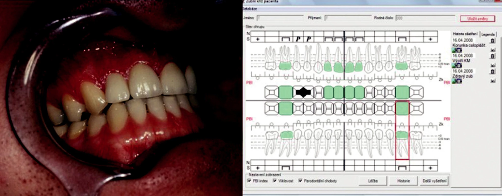 Celokeramické korunky in situ a analýza výsledku pomocí interaktivního zubního kříže.