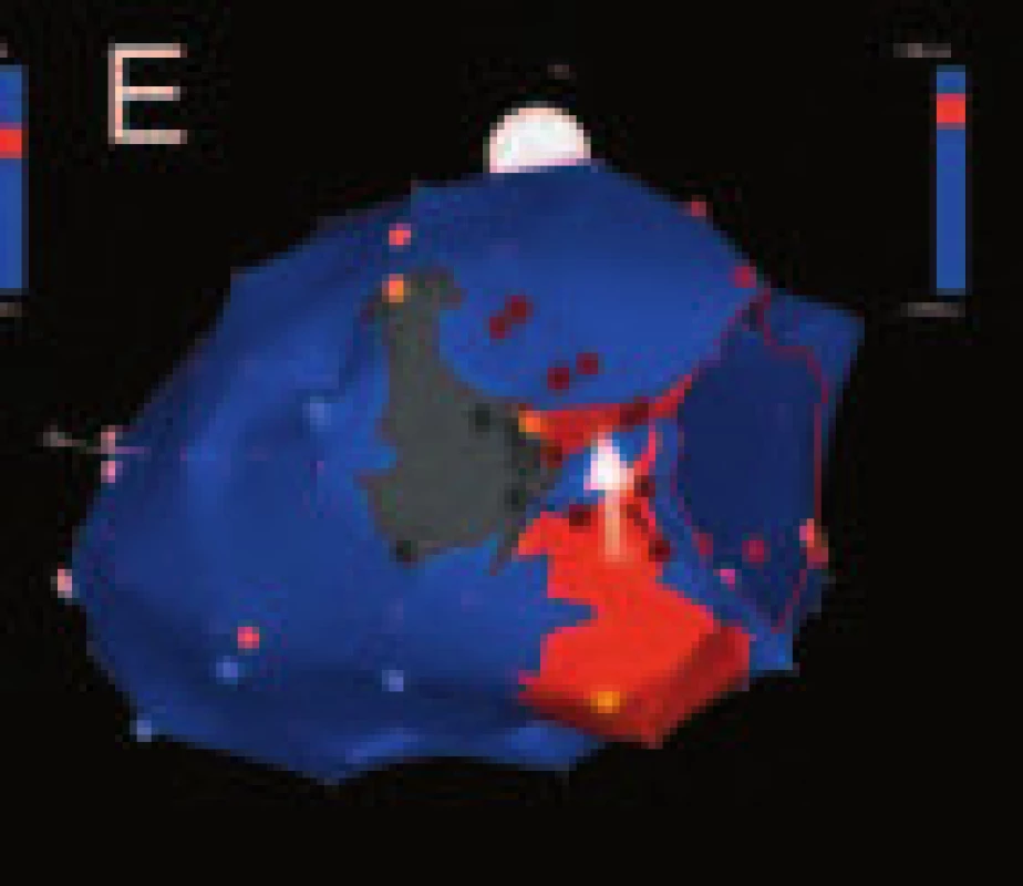 Rozfázovaná elektroanatomická propagační mapa (panely A–E) levé komory srdeční (pohled zezadu z laterální strany) získané mapováním při komorové tachykardii reentry typu u nemocného po laterálním infarktu myokardu.