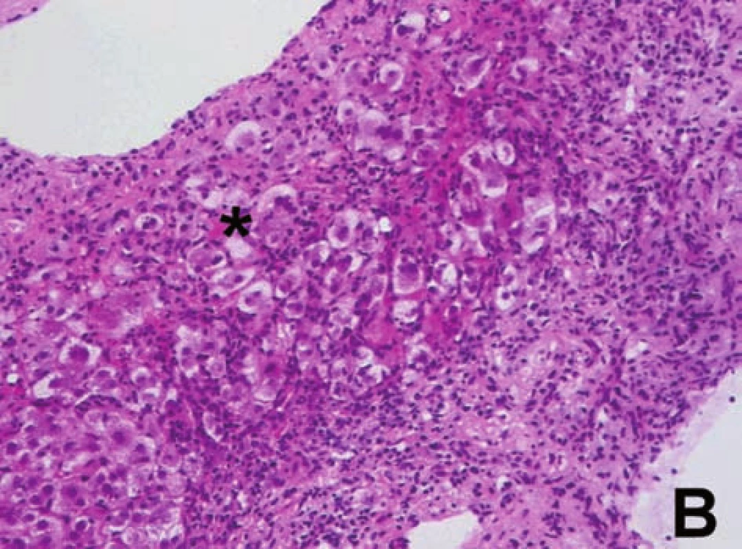 A, B. Charakteristické změny pro AIH:
a) přítomnost plazmatických buněk v zánětlivém infiltrátu (ozn. šipkami) v rozšířeném portálním poli, navíc známky výrazné periportální hepatitidy (obr. A).
b) přítomnost tzv. rozet hepatocytů (ozn. hvězdičkou) – sekvestry částečně dystrofických jaterních buněk obklopených zánětlivým infiltrátem (obr. B).
Fig. 8A, B. Changes characteristic for AIH:
a) presence of plasma cells in the inflammatory infiltrate (marked with arrows) in the extended portal field; moreover there are signs of marked periportal hepatitis (Fig. A)
b) presence of sc. hepatocyte rosettes (marked with asterisk) – sequesters of partly dystrophic liver cells surrounded by inflammatory infiltrate (Fig. B).