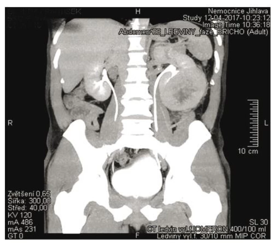 Tumor levé ledviny při stanovení diagnózy