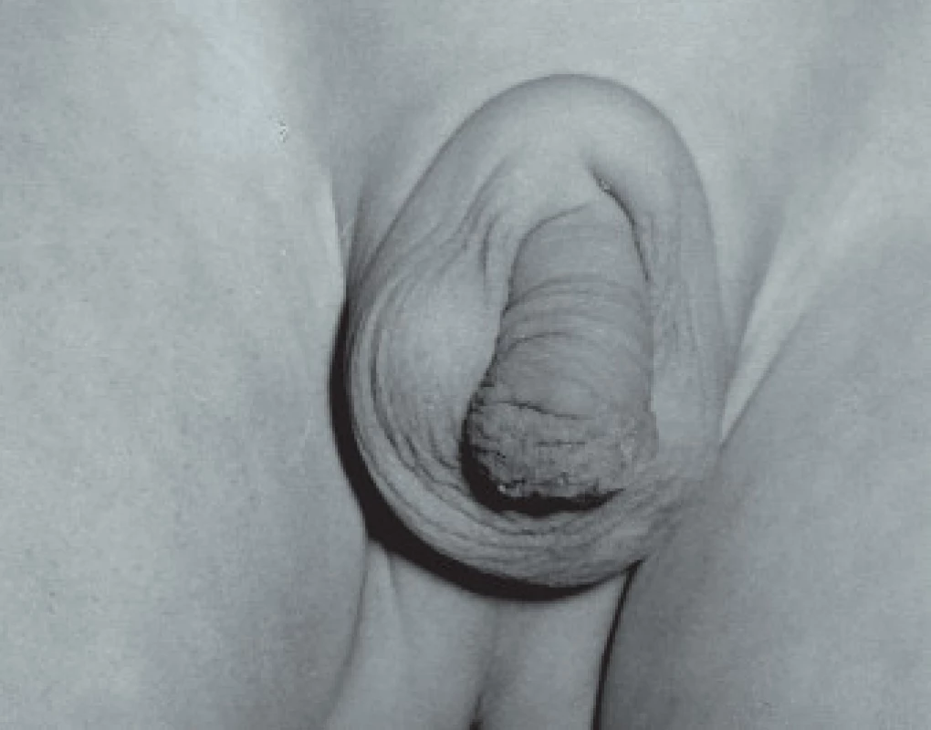 Neúplná penoskrotální transpozice, nazývaná též šálové skrotum. Penis je uložen částečně uvnitř šourku.