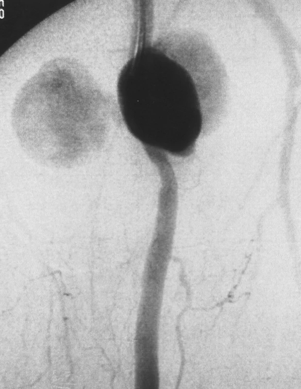 Digitálna subtrakčná angiografia stehna
Pic. 1. Digital subtraction angiography of the thigh