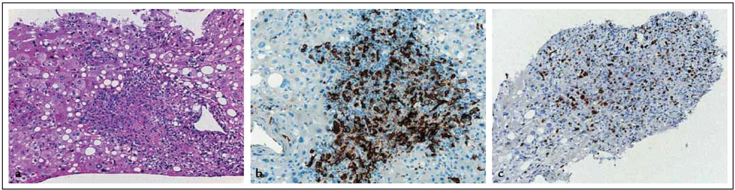 Imunohistochemický obraz nálezu jater postižených lymfomem. a: hematoxylin-eozin (zvětšeno 20krát), b: CD20 (zvětšeno 20krát), c: MIBI1 (zvětšeno 20krát) (laskavostí as. MUDr. J. Stříteského, CSc.).