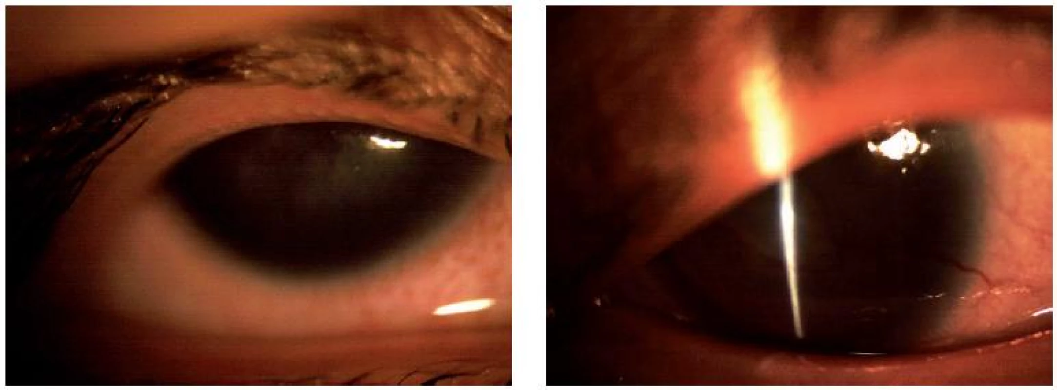Pacientka II-1: pravé (A) a levé oko (B), aniridie, vyšší stupeň AAK.