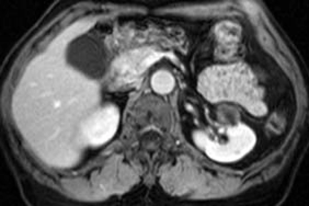 Drobný cystoidní Grawitzův nádor levé ledviny.