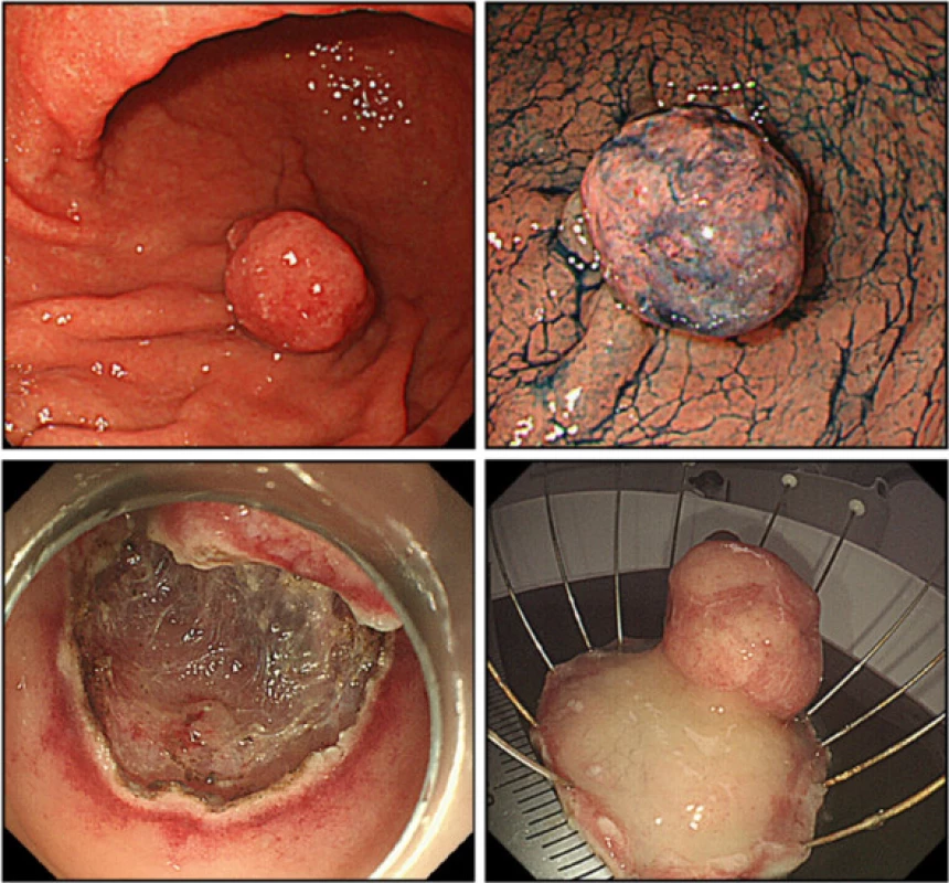 Endoscopic submucosal dissection. En bloc endoscopic submucosal dissection was performed for the pedunculated polyp, measuring 20 mm in diameter, on the greater curvature of the lower gastric body