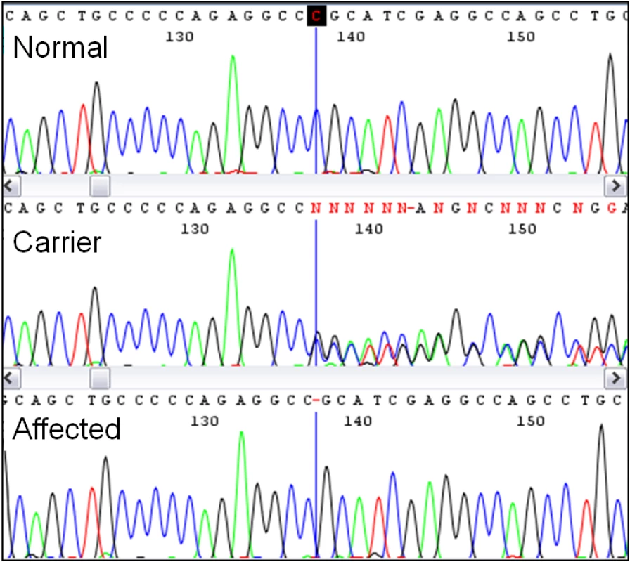 Discovery of the Lavender Foal Syndrome–associated single base deletion by sequencing.