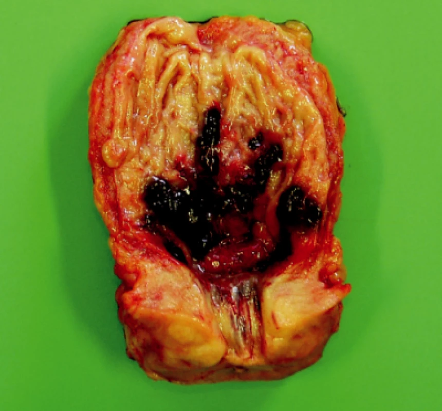 Rozstřižený močový měchýř s prokrvácenou sliznicí na zadní stěně, u 70letého muže 10. den po zavedení PK – současně benigní hyperplazie prostaty a koncentrická hypertrofie stěny
měchýře (zmenšeno 0,6×)