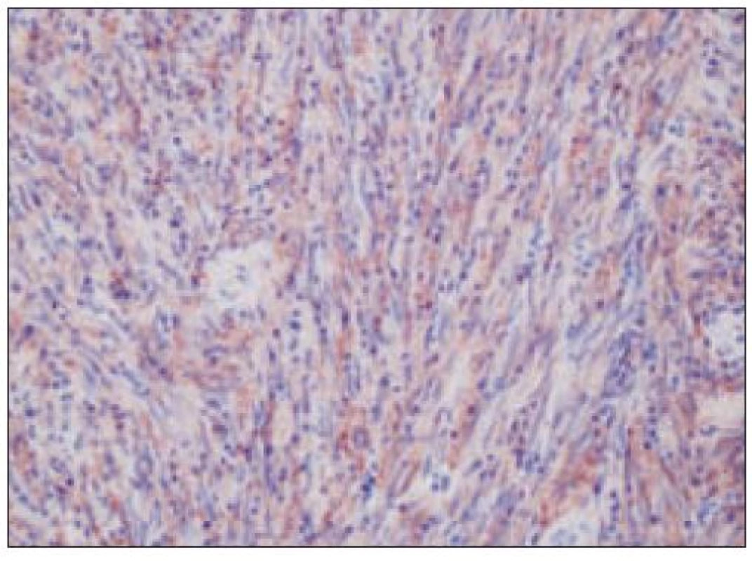 Sarkóm folikulových dendritických buniek, CD35&lt;sup&gt;+&lt;/sup&gt; (Giemsa, 20krát).