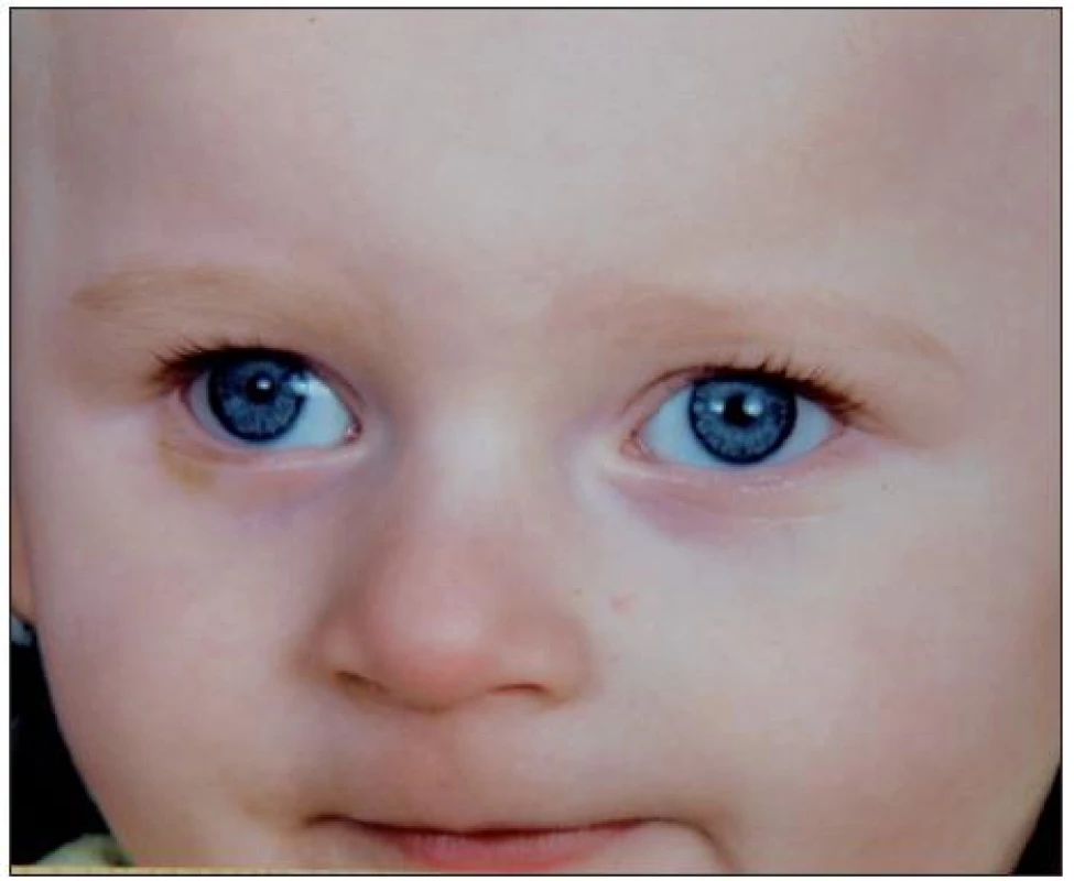 Typický fenotyp dítěte s Angelmanovým syndromem (detail obličeje)
(publikováno se svolením rodičů dítěte, fotoarchiv OLG Ostrava)
