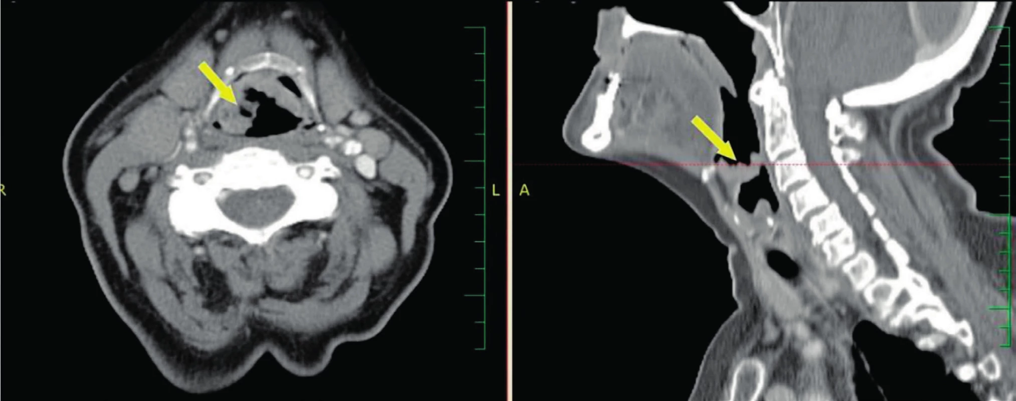 CT snímky s kontrastem - šipka ukazuje na supraglotický karcinom stadia T2.