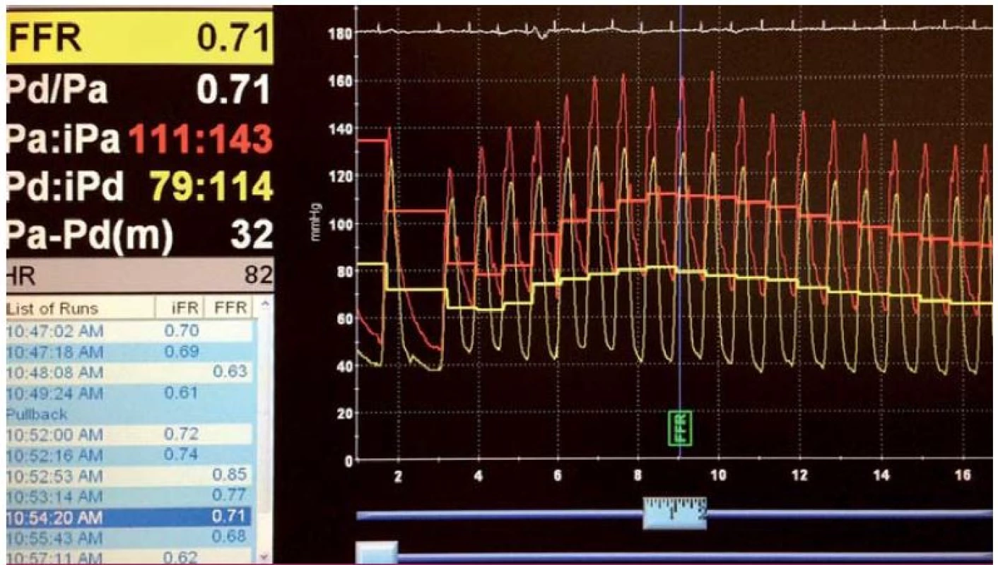 FFR angiograficky hraniční stenózy RIA, tlakový gradient na stenóze při hyperemii adenozinem s hodnotou FFR 0,71 svědčí pro hemodynamicky významné postižení.
Červená křivka odpovídá tlaku v aortě, zelená křivka tlaku z intrakoronárního vodiče za stenózou.