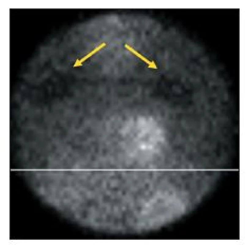 Vybraný snímek tomografické studie, při níž pacient ležel na břiše. Odstínění záření v horní části obrázku (šipky) je způsobeno šrouby, kterými byla k vyšetřovacímu lůžku gamakamery připevněna deska prodlužující lůžko. Pacient měl být uložen tak, aby toto místo bylo mimo zorné pole.