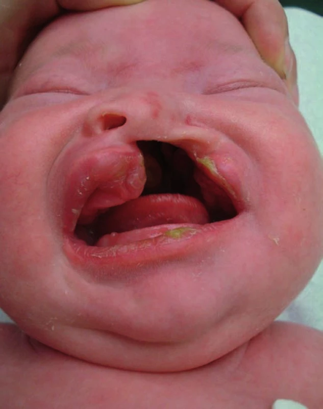 Pacient s celkovým jednostranným rozštěpem před operací v 1. týdnu života.
Fig. 1. Patient with a total unilateral cleft palate before the surgery in the first week of life.