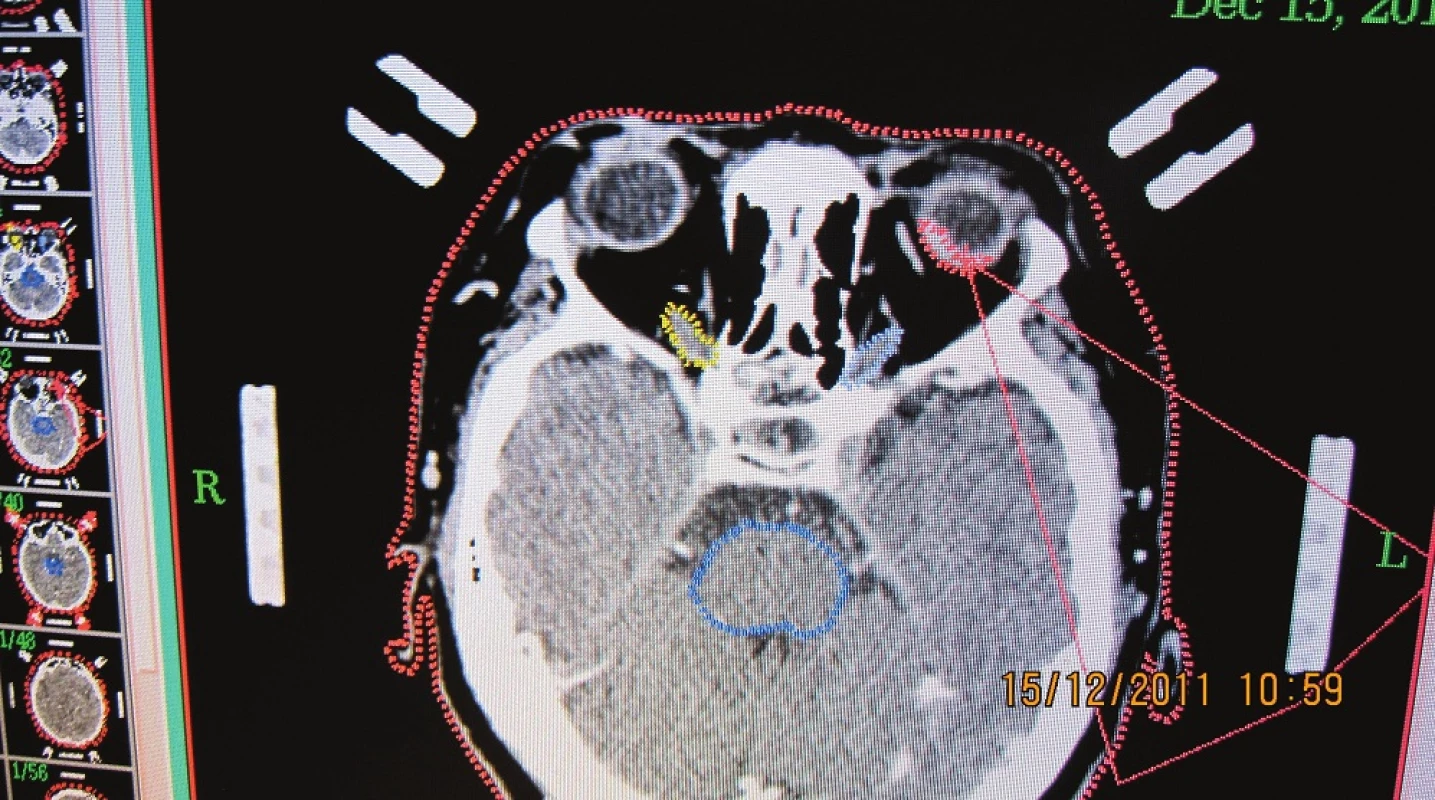 CT obraz pacientky s naloženým stereotaktickým kruhom - nádorové ložisko označené červenou farbou