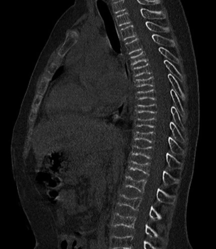 CT obraz bikonkávnej deformácie tiel stavcov.
Fig. 2. CT – biconcave vertebral body deformation.
