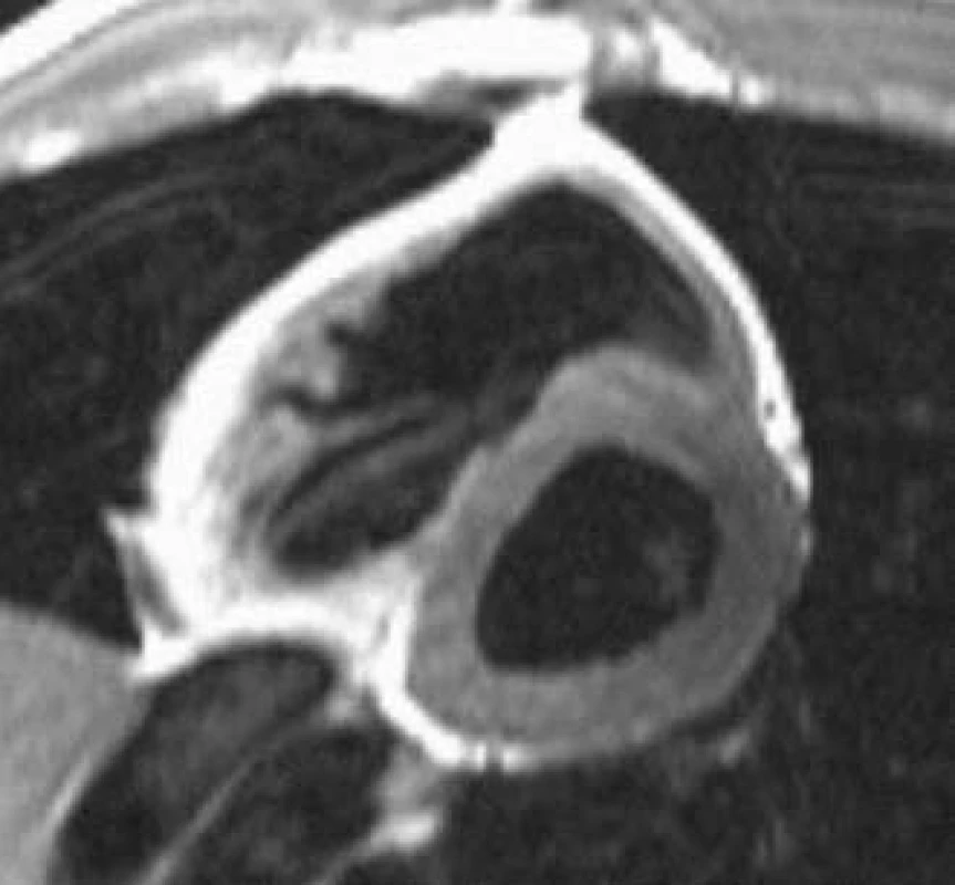 Arytmogenní kardiomyopatie pravé komory. Tuková degenerace myokardu baze pravé komory (světle šedě při T1 váženém zobrazení).